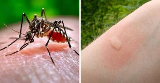 Kousnutí komárů na kůži