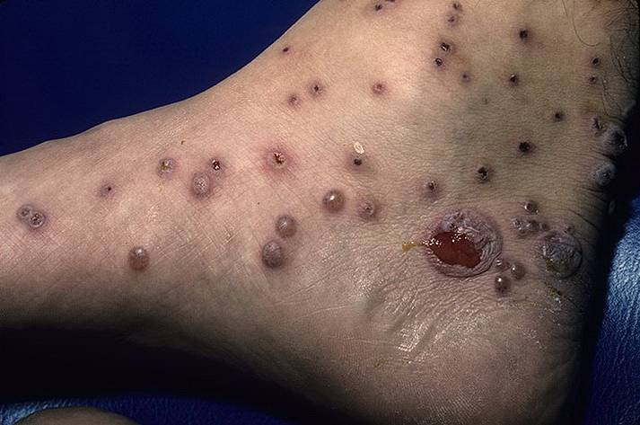 Mosquito bite leg photo