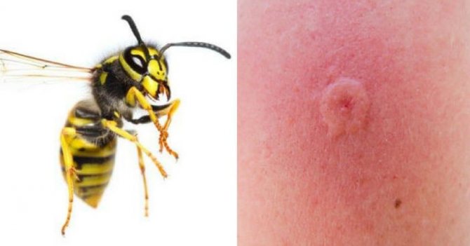 Înțepătura viespei pe piele