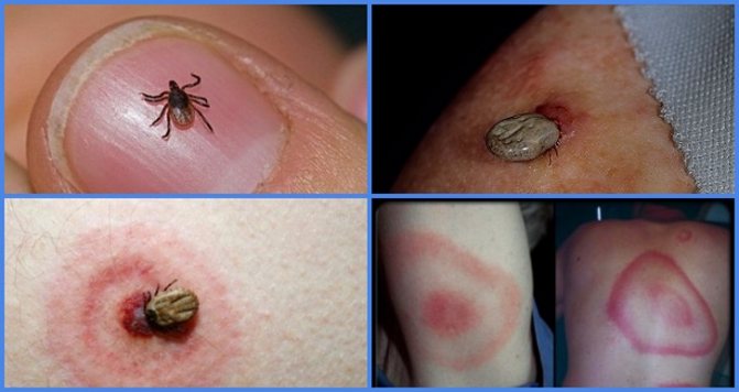 Tick ​​bites are dangerous only if the insect is a carrier of a disease