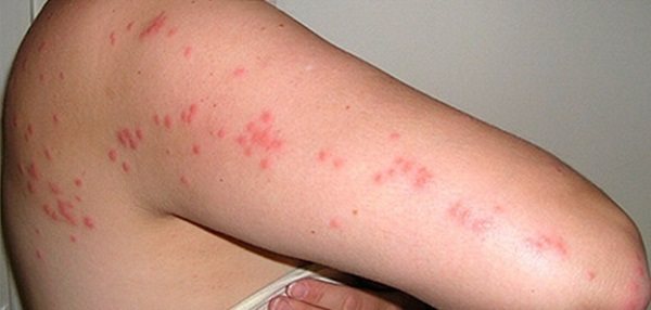 Bedbug bites are dangerous