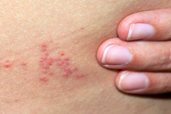 Bedbug bites on the body