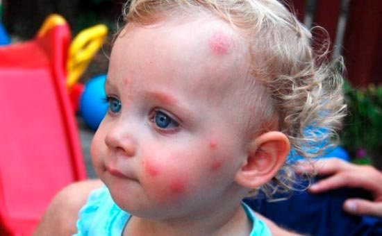 Bedbug bites in a child: photo