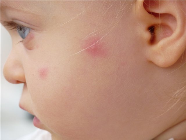 Mușcăturile de țânțar la copii fotografie pe față
