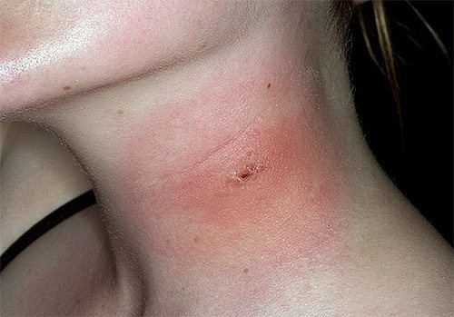 Swelling and inflammation appear almost immediately in the stung area.
