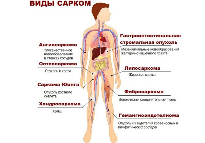 Mga uri ng sarcomas