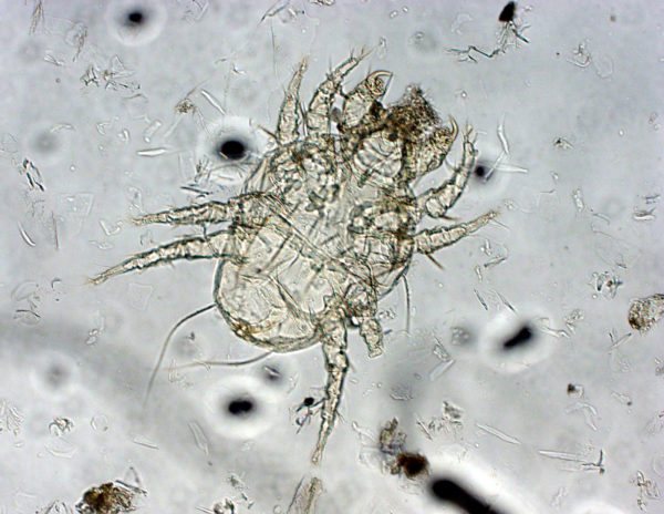Сърбежът се причинява от микроскопични акари, които живеят в епидермиса.