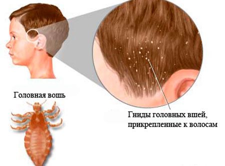 Lice in humans types and routes of infection
